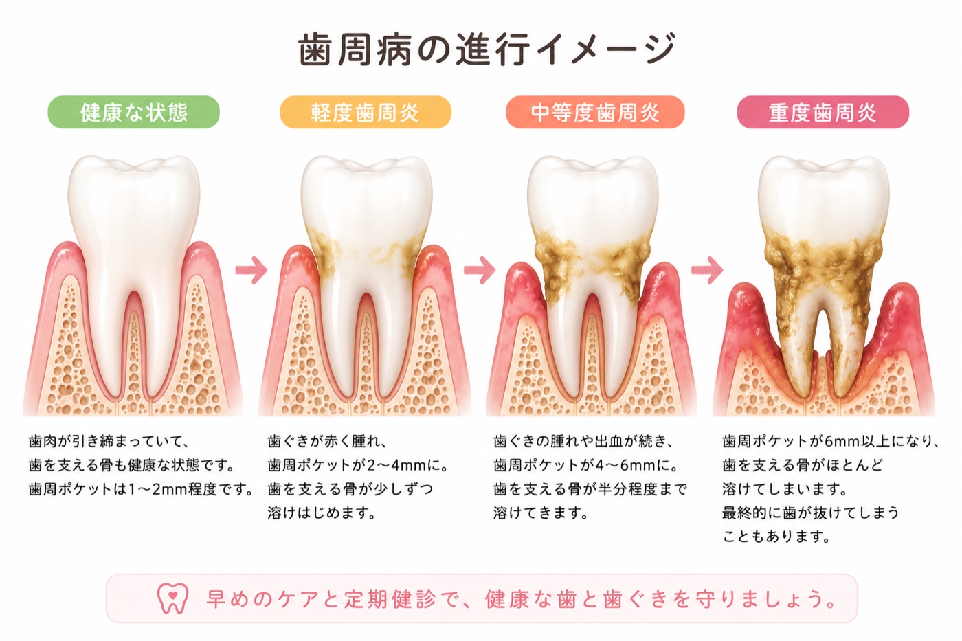歯周病の進行イメージ（健康な状態から重度歯周炎まで）